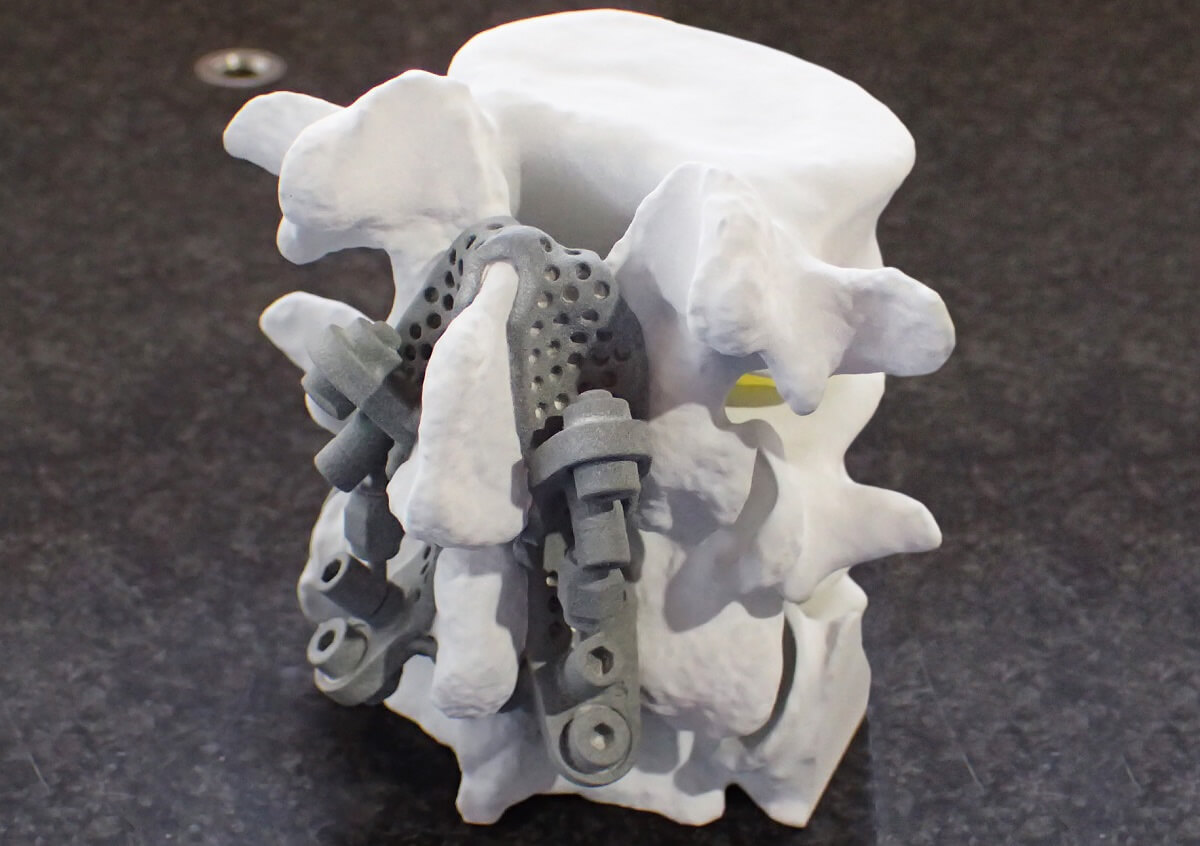 3Dプリンターで医療が変わる！金属技研が挑む革新的インプラント